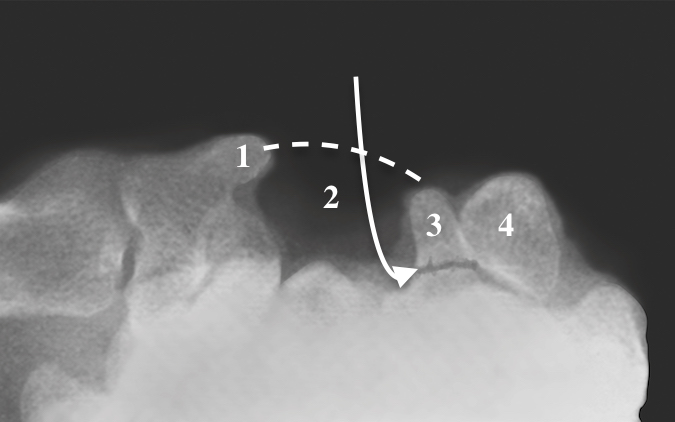 HAMATE HOOK OF HAMATE FRACTURES Hand Surgery Resource